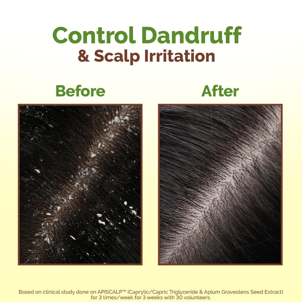 Mamaearth Lemon Anti-Dandruff Hair Oil 100ml